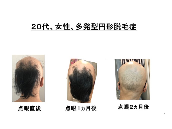 円形脱毛症　病院